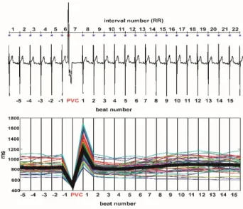 Table 1. Clinical stages of Chagas’ heart disease  Stage  ECG  Echocardiogram  Heart Failure 