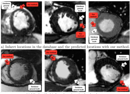 Fig. 4. The white arrows represent the database ground truth, whereas the red arrows show the infarct location that was predicted with our method