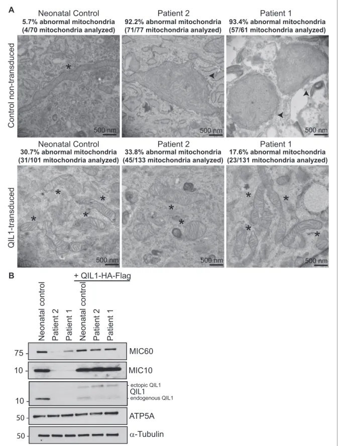 Figure 4. Ectopic QIL1 expression rescues mitochondrial morphological defects in patients’ fibroblasts