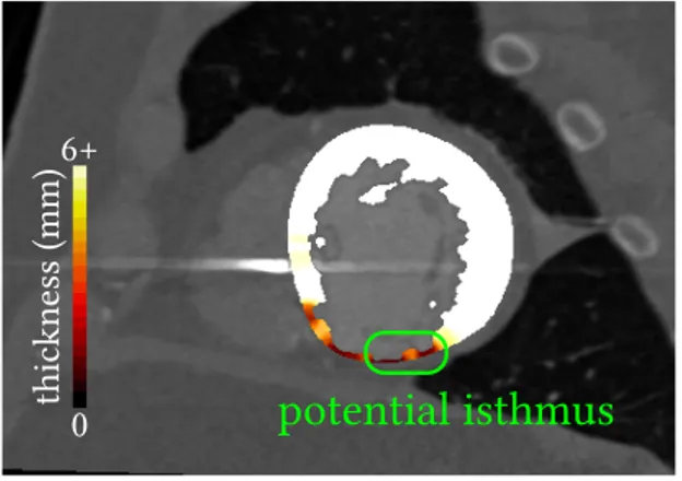 Fig. 2. A typical VT isthmus as seen on CT images. Thinner zones surround a moderate thinning in the myocardial wall