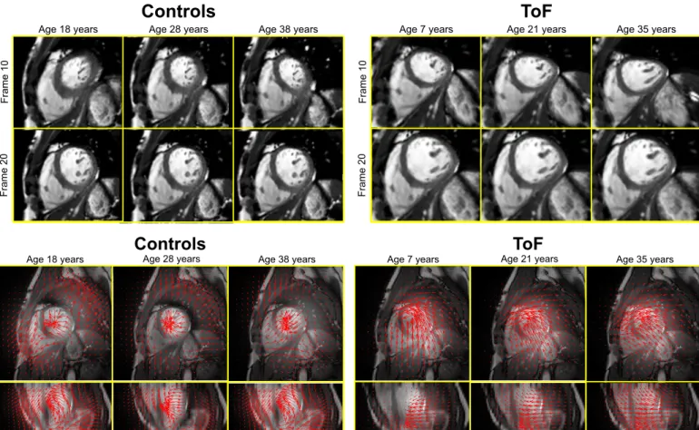 Fig. 8: Snapshots of the motion at ±2 standard deviations and at the mean for the control group (top) at frame 10 (corresponding to the end-systolic frame), and frame 20  (cor-responding to the end of relaxation) and the cor(cor-responding deformation fiel