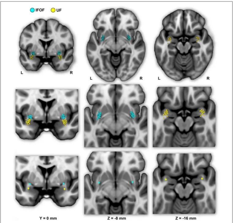 Figure 4 shows the individual and mean center of mass locations of the IFOF and UF stems as points projected on a single-subject MNI T1 brain