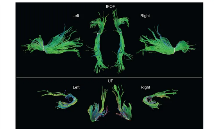 FIGURE 5 | Examples of both left and right IFOF and UF of a typical subject extracted using the stem-based anatomical virtual dissection and shown with their stems (white)
