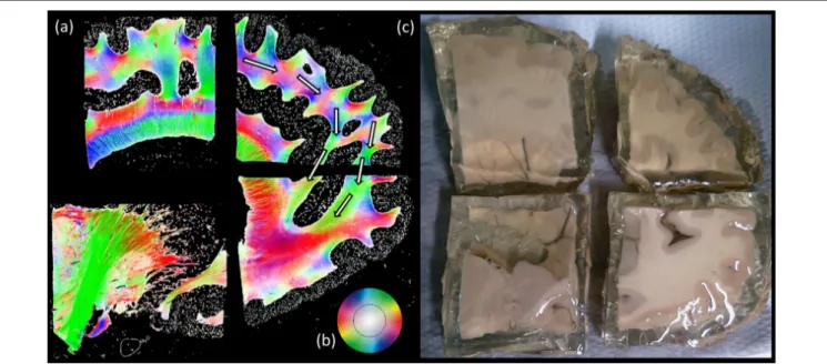 FIGURE 8 | Polarized light imaging (PLI) results. (A) Four separate blocks of the same brain sliced in sagittal plane, where the fiber orientation maps are depicted correspond to the (B) color scheme circle