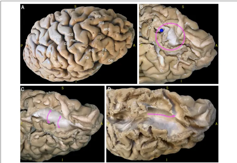 FIGURE 10 | (A) The main sulci and gyri of the lateral frontal region of a right hemisphere are indicated, after removal of vessels, pia mater, and arachnoid membranes