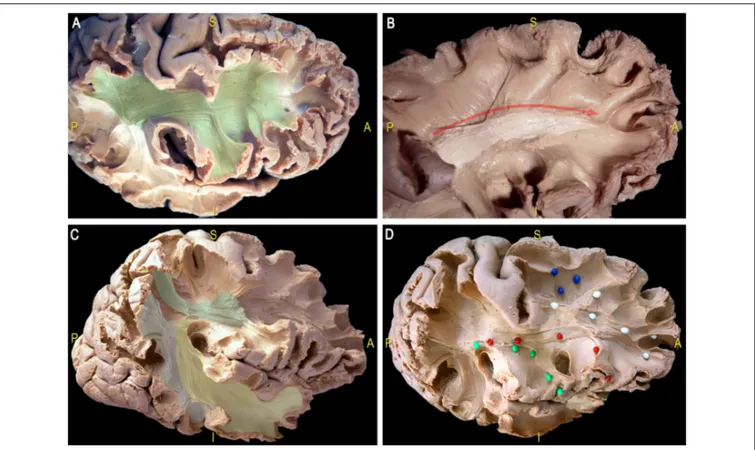 FIGURE 11 | Dissection of a right hemisphere according to Klingler’s technique. (A) Exposition of the most ventral components of the anterior indirect component of the SLF (SLF II and SLF III; green area)