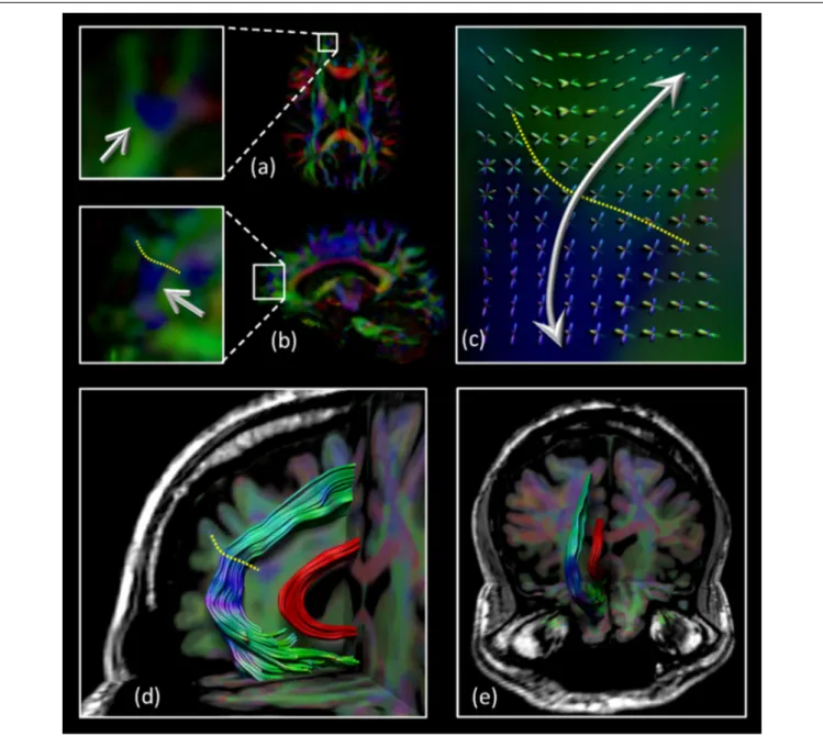 FIGURE 2 | Location of the SAF: the axial (A) and sagittal (B) view of part of the region that intersects the SAF (blue region indicated by the arrows)