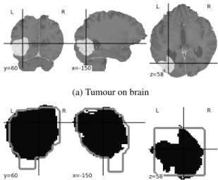 Table 1: Tumour detection results on the TCGA-GBM dataset. IOU : Intersection Over Union