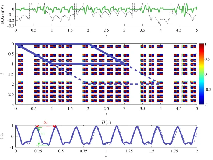 Figure 1. Top panel: 5-second sample ECG (lead V 1 ). Thin broken line indicates the post-filtered ECG, whereas thick green line indicates the ECG after all processing steps