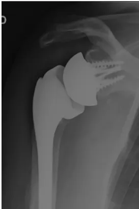 Figure 3 Malunion of greater tuberosity. Figure 4 Excision of greater tuberosity.