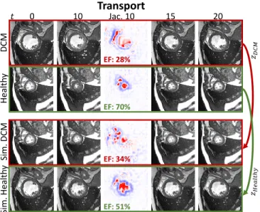 Fig. 8. Transporting the motion matrix z from one subject and combining it with the end-diastolic frame of another subject allows for simulating a disease (dilated myopathy, DCM, red motion) in a healthy subject and vice versa (green motion)