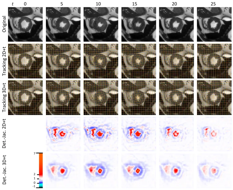 Fig. 5. Showing 2D+t and 3D+t tracking results of the warped moving image I 0 with grid overlay and the Jacobian determinant (Det.-Jac.) for the mid-ventrical slice of a test sequence