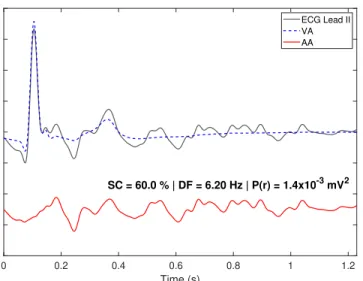 Fig. 4: Original recording, VA and AA estimates in lead II by the L¨owner-based BTD of Patient P7