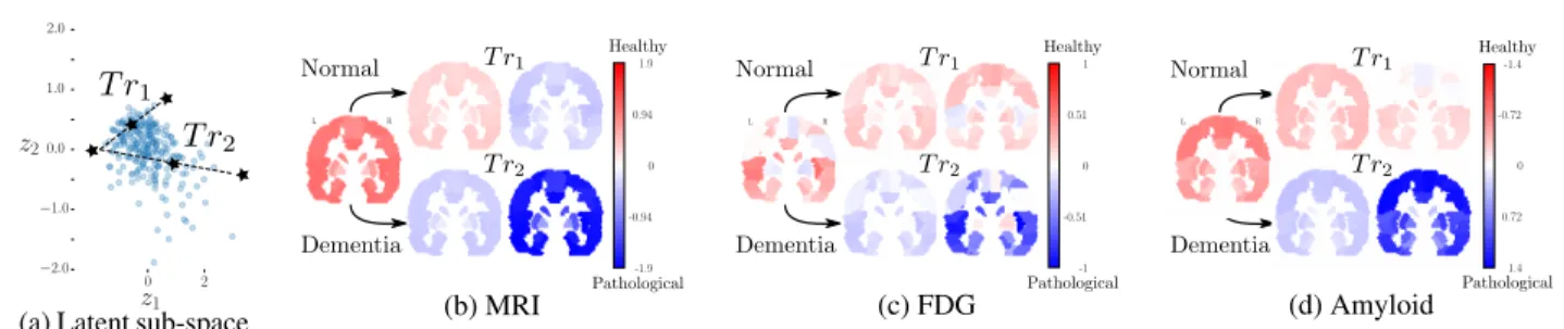 Figure 5: Generation of imaging data from trajectories in the latent space. (a) Normal aging trajectory (T r 1 ) vs Dementia aging trajectory (T r 2 ) in the latent 2D sub-space (cfr