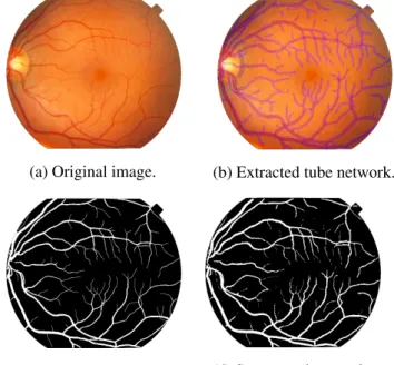 Table 1. Results on STARE dataset (SV is supervised, USV is unsupervised) Method Se Sp Acc G 2nd observer 0.8956 0.9381 0.9346 0.9166 S Fraz et al.(2012) 0.7548 0.9763 0.9534 0.8584 V Orlando et al.(2017) 0.7680 0.9738 0.9515 0.8648 Oliveira et al.(2018) 0