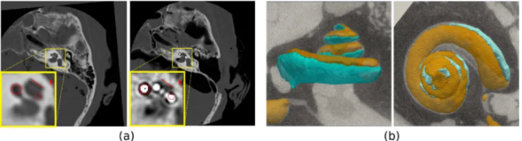 Fig. 1. (a) Pre-operative (Left) and post-operative (Right) CT imaging of the inner ear.