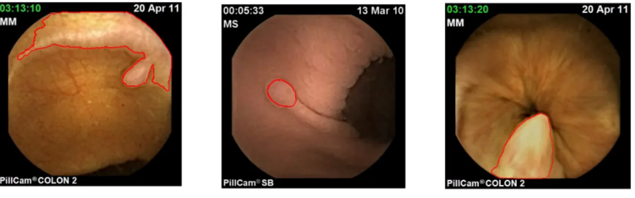 Fig.  10:  WCE  image  segmentation  using  histogram-based  active  contour  approach  with  KL  divergence