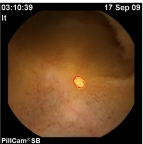 Fig.   11     WCE image segmentation of  Fig.  8  plus,  in  yellow  colour,  the  manual  segmentation  performed  by  the clinician
