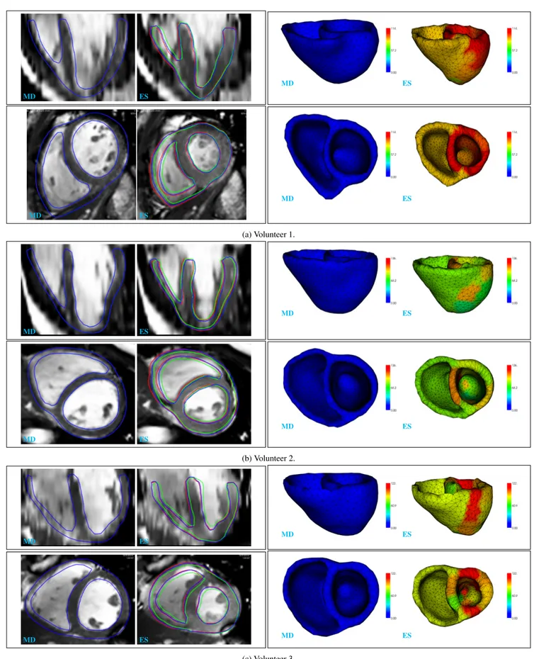 Figure 11: Volunteer data. Results at mid diastole (MD) and end systole (ES). Left: heart geometries overlapped with images, with red, green, and blue representing personalized kinematics, initializations, and personalized simulations respectively