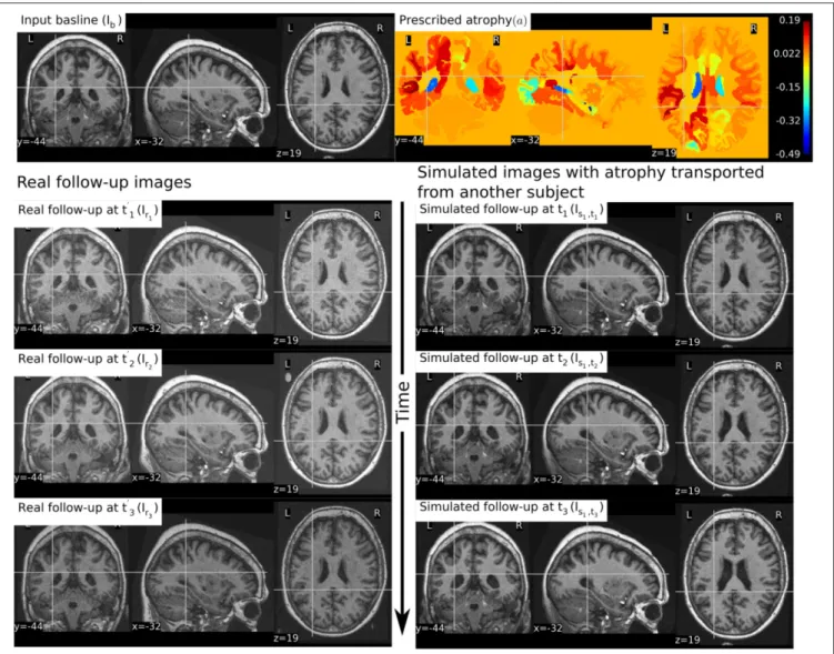 FIGURE 9 | The figure shows an example of simulating follow-up images of a normal subject with baseline image I b , where the prescribed atrophy pattern is adapted from an AD patient