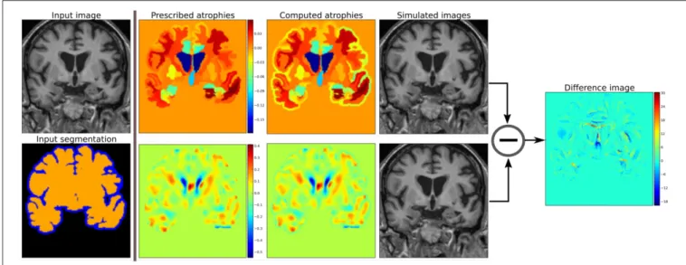 FIGURE 2 | Examples of two different kinds of atrophy maps. The first row prescribes an atrophy map that is uniform in different regions of the brain, while the second row prescribes a smoothly varying atrophy
