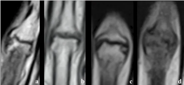 Fig 1. MRI joint structural features. a.: osteophytic feature (O) b.: erosive feature (E) c.: erosive and osteophytic lesion feature (E/