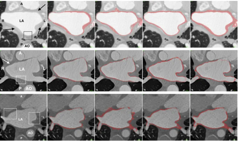 Fig. 6. From the CT image database. Each row represents a separate case. Each column represents (from left to right): original CT, manual segmentation for ground truth,  ROBI, LUMC  and  INRIA