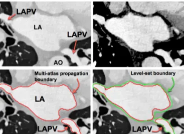Fig. 3. Intermediate steps in the LUMC  method.  Top row left to  right:  Original CTA,  wall  enhancement