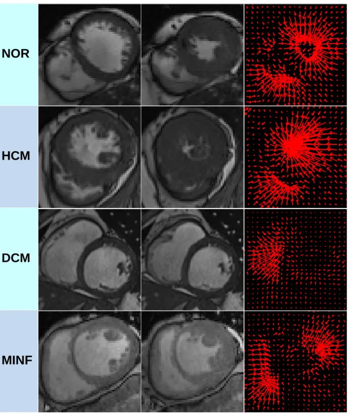 Fig. D.9. Four examples of the apparent flow generated by the ApparentFlow-net of 4 ACDC training set cases in di ff erent pathological categories