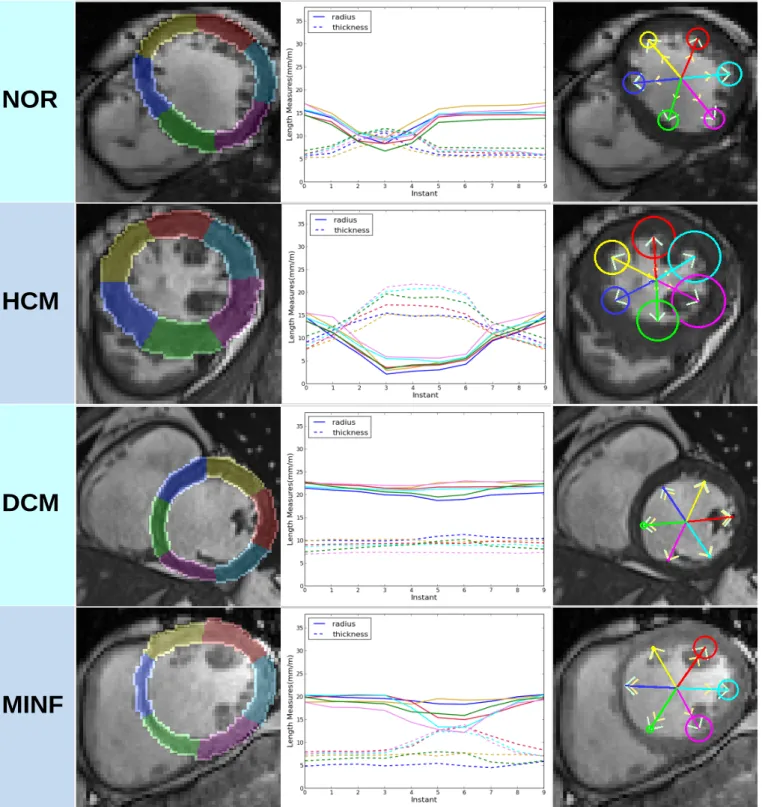 Fig. 6. Examples of typical slice from 4 of the 5 pathological categories in ACDC. 1st column: the segmentation of the 6 myocardial segments (the boundaries of the segmentation masks are marked by lighter colors)