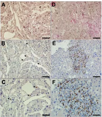 Figure 3. Immunohistochemistry of CD8 in adrenocortical carcinoma (ACC). (A and D) Low  magnification (20×) images of hematoxylin and eosin stain (HE) of ACC