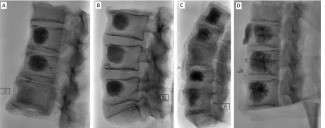 FIGURE  5.  Fluoroscopy  images  of  human  cadaveric  vertebrae  blocks  after  injection  of  CPCs  loaded  with  various  amounts  of  Xenetix  (inje cted  volume:  ca