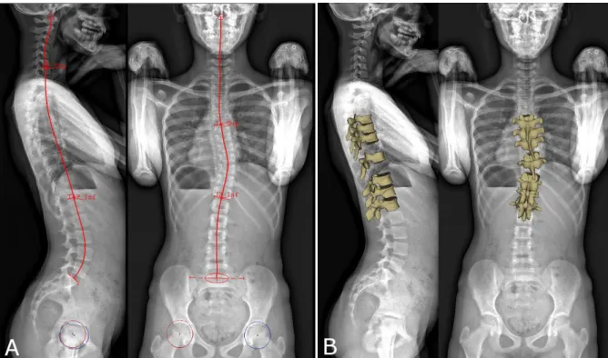 Fig. 1 (A) Manual initialization of the 3D reconstruction.  The sacral plate, acetabula and the spinal  midline  from  the  odontoid  apophysis  of  C2  vertebra  to  L5  lower  endplate  were  selected  in  both  views