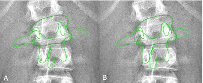 Fig. 2 Position of the vertebral model for apical vertebra (L2) before (panel A) and after manual adjustment