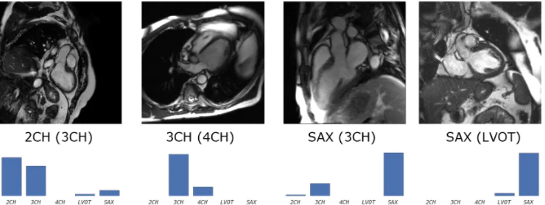 Figure 11. Example misclassifications using CardioViewNet. Predicted and true label (in parentheses) are indicated under the images and below them are view-specific prediction confidences