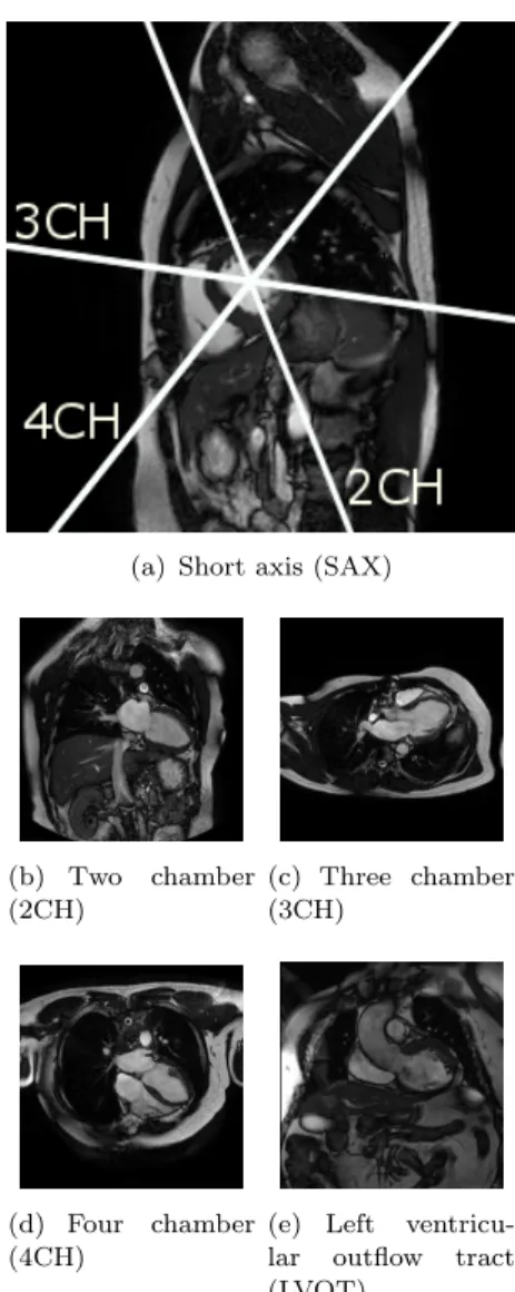 Figure 1. Examples and mutual positioning of the short and the main left ventricular long axis cardiac MR views used in this paper