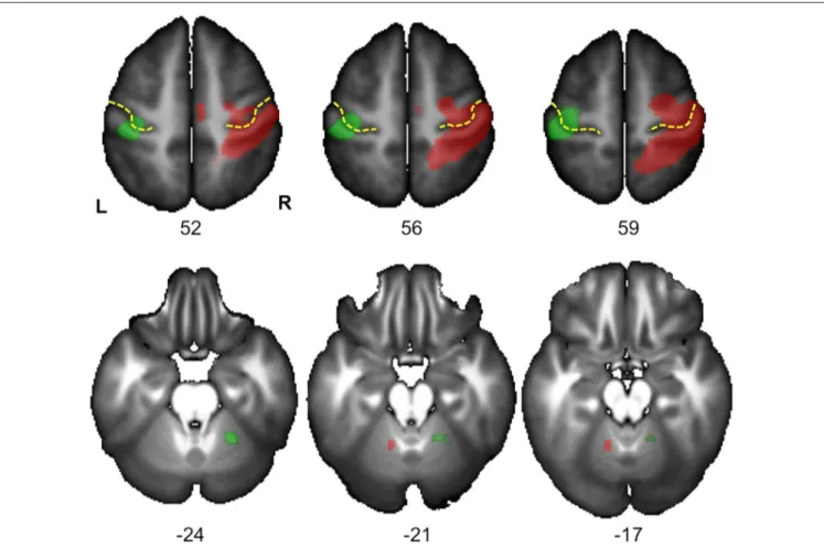 FIGURE 4 | Statistical parametric maps (SPM) for the right Hand minus left Hand (in green) and left Hand minus right Hand (in red) contrasts in the 278 subjects who responded with their right hand