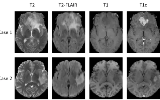 Figure 4: Examples of multisequence MRI from the BRATS 2018 database. While T2 and T2-FLAIR highlight the edema induced by the tumor, T1 is suitable for determining the tumor core