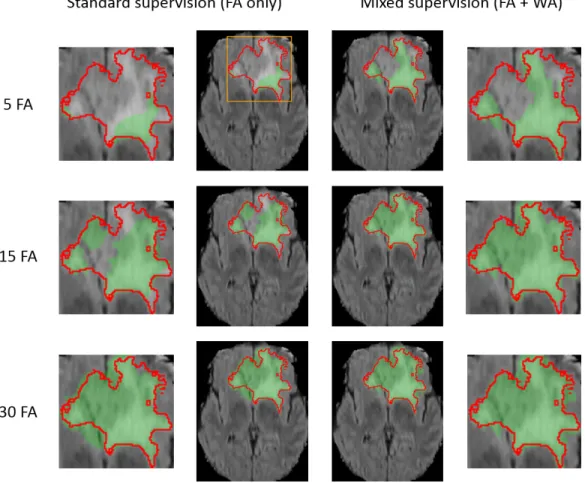 Figure 5: Comparison of our approach with the standard supervised learning for binary segmentation of the ’whole tumor’ region