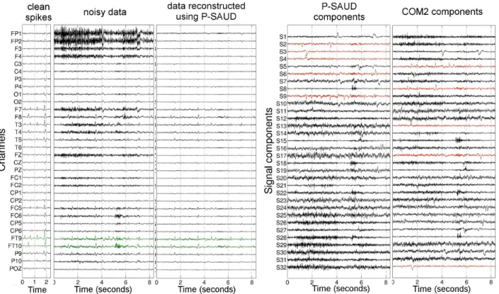 Fig. 7. Real EEG recordings of patient 3: 2.5 s of clean spikes and 8.5 s of noisy data, data reconstructed using P-SAUD, and signal components extracted with P-SAUD and CoM 2 