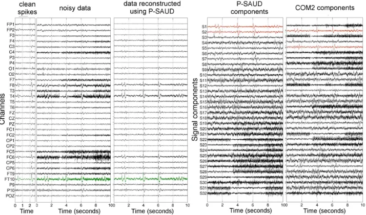 Fig. 5. Real EEG recordings of patient 1: 2.5 s of clean spikes and 10 s segment of noisy data, data reconstructed using P-SAUD, and signal components extracted with P-SAUD and CoM 2 