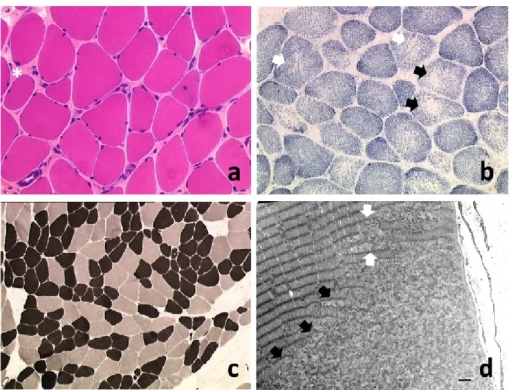 Figure 1. Main histopathological findings in SEPN1-RM. Transversal sections of frozen muscle samples (a–b 20 × , c 10 × );