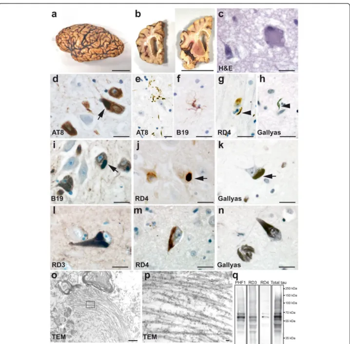 Fig. 1 de novo mutation of MAPT -G335A led to severe brain atrophy with glial and neuronal tau pathology constituted of 3R and 4R tau