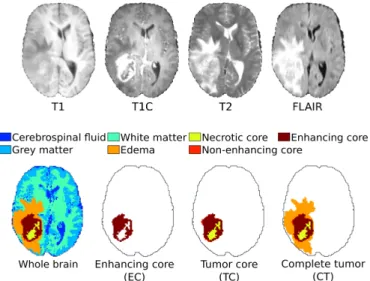 Fig. 1: MR channels (top row) ; whole brain segmentation and mutually-inclusive pathological regions (bottom row).