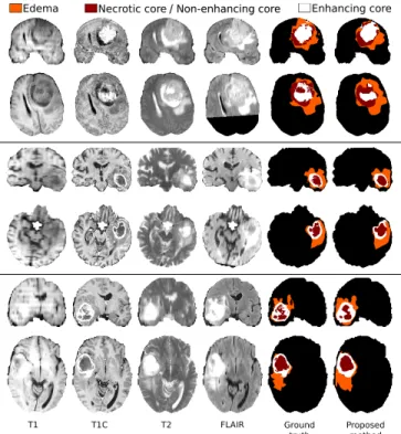 Fig. 9: Left: recall of glioma detection for the complete tumor, reported for cases grouped by year and grade