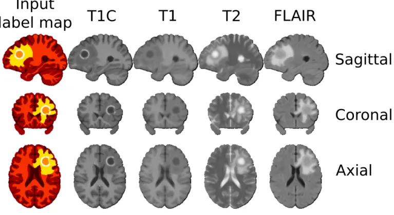 Fig. 8: Illustration of the modularity of our image synthesis model. Synthetic 1 mm isotropic MRI, obtained after 3 iterations, based on a categorical label map generated by the PIHNA tumor growth 3D model.