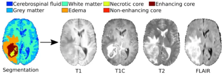 Fig. 1: The generative model aims at synthesizing subject- subject-specific MRI, provided a label map of a pathological brain.