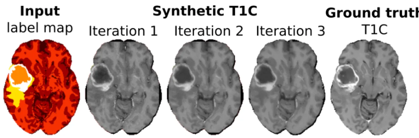 Fig. 5: From left to right: input label map, synthetic contrast-enhanced T 1 -weighted MRI after iterations t = 1, 2, 3, and ground truth (real MRI)