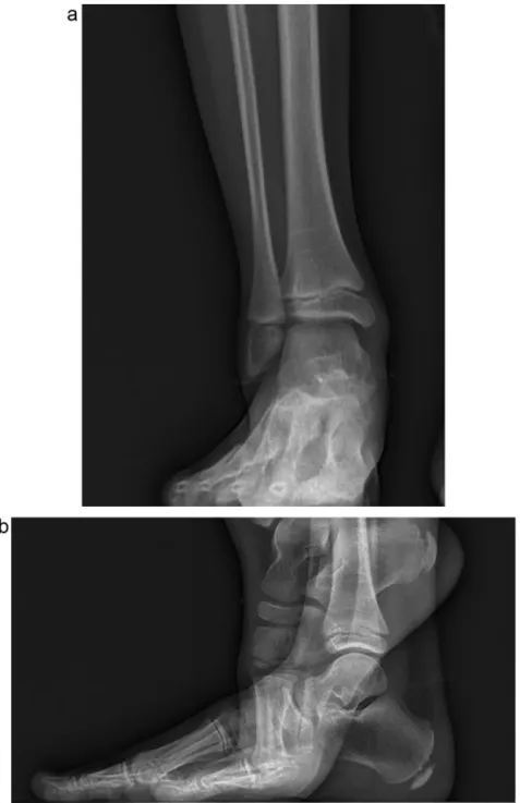 Fig. 4. A. Calcanei, coronal view: point AC cannot be identiﬁed on this view. B. Calcaneum, lateral view: point PC is difﬁcult to identify due to the insufﬁcient ossiﬁcation.