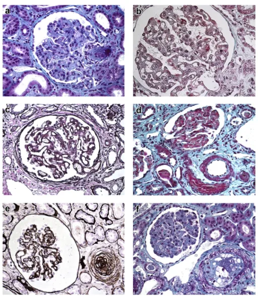 Figure 2. Glomerular and arteriolar lesions of thrombotic microangiopathy in patients with cobalamin C (cblC) de ﬁ ciency